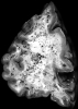  Innumerable pericapillary hemorrhages secondary to cerebral fat embolization